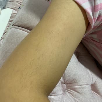 Lazer Epilasyon Seanslarında Hayal Kırıklığı