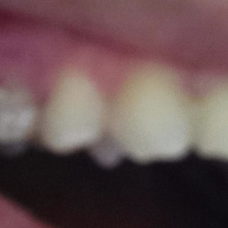 Kanal Tedavisi Sonrası Hayal Kırıklığı: Kırılan Diş Ve Kötü Muamele