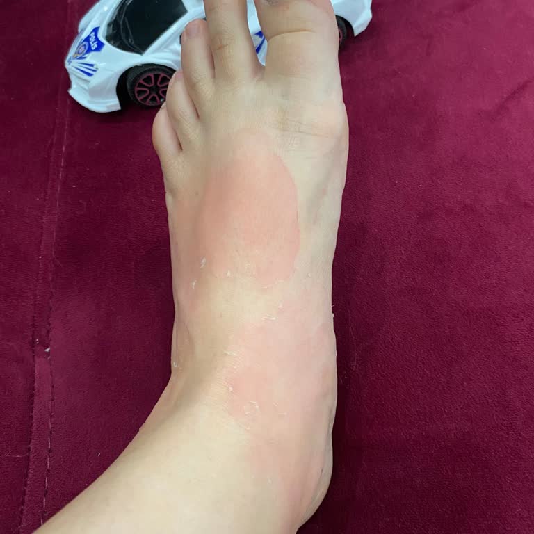 Ayak Peeling Maskesi Sonrası Yanık Ve Kaşıntı Sorunu