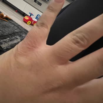 Fairy Limonlu Deterjan: Alerjik Reaksiyon Ve Egzama Sorunu