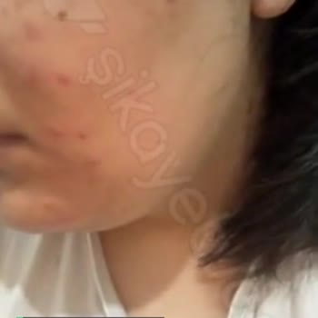 La Roche - Posay Yüz Temizleme Seti Cildimi Mahvetti!