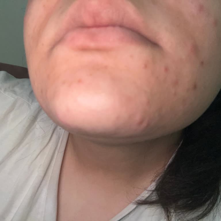 La Roche - Posay Yüz Temizleme Seti Cildimi Mahvetti!