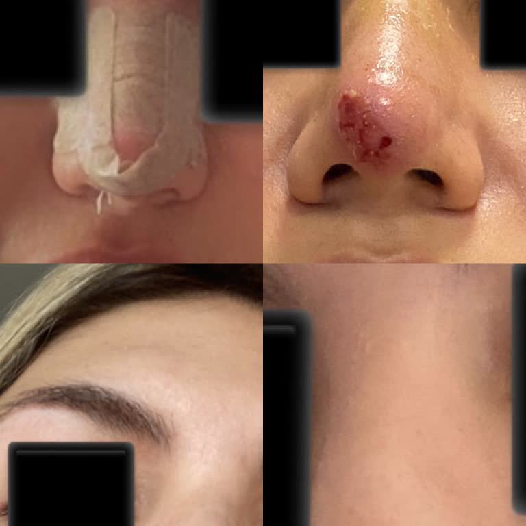 Rinoplasti Sonrası Nekroz Ve İz Bırakan Deneyim