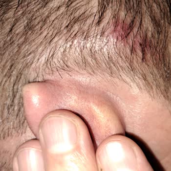 Bioxcin Şampuan Yan Etkisi: Kulağımda Ağrı Ve Yara