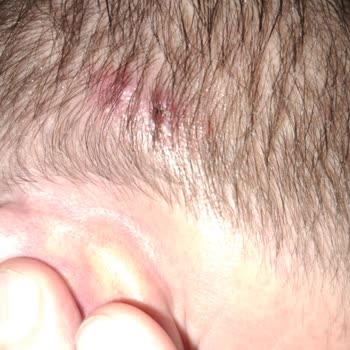 Bioxcin Şampuan Yan Etkisi: Kulağımda Ağrı Ve Yara