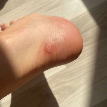 Mis zapatos Bershka me causaron heridas en 2 días