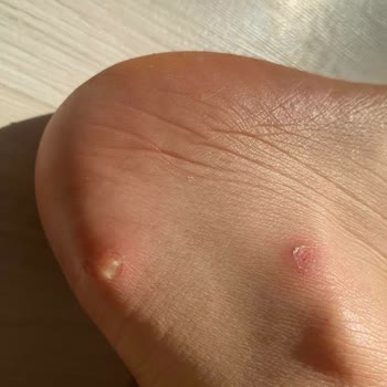 Mis zapatos Bershka me causaron heridas en 2 días