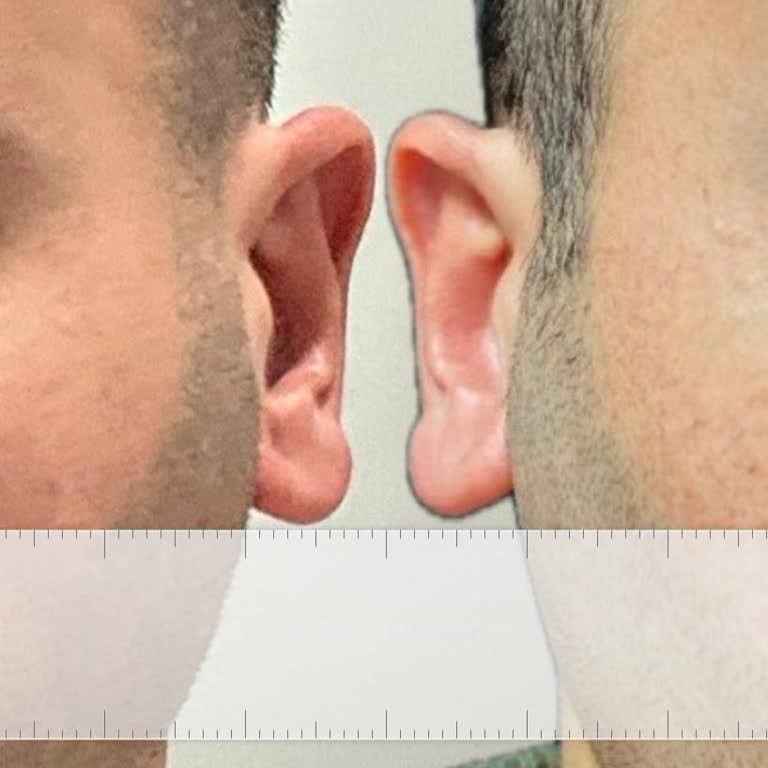 Kulak Ameliyatında Yaşanan Hayal Kırıklığı