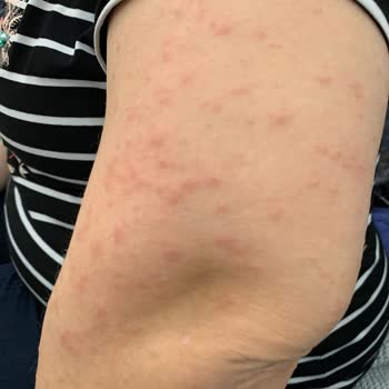 Yumoş Ürünü Ciltte Tahrişe Yol Açtı