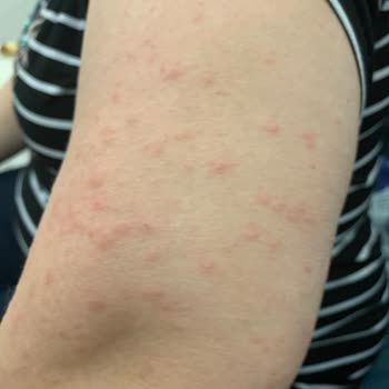 Yumoş Ürünü Ciltte Tahrişe Yol Açtı