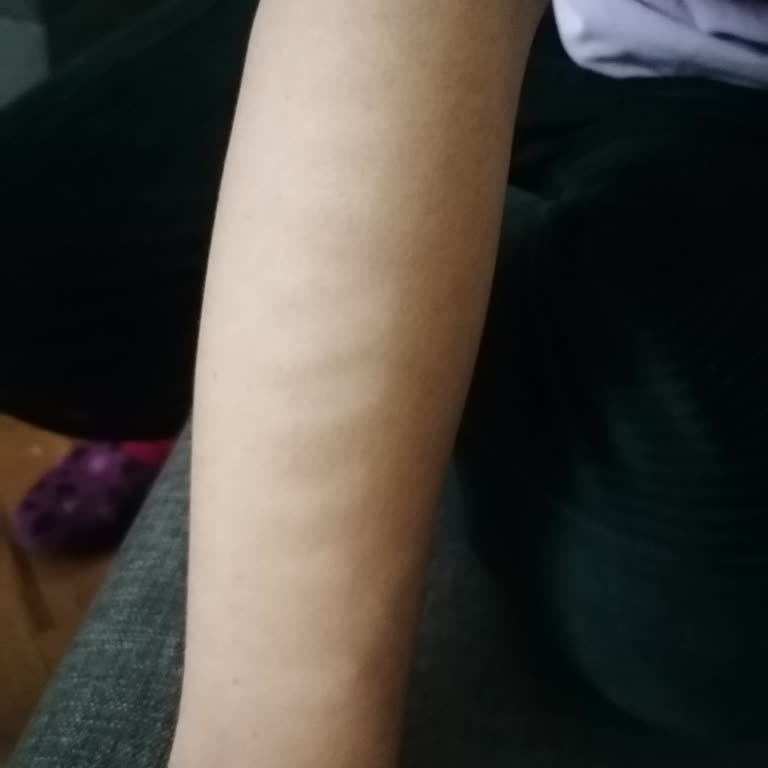 Lotus Güzellik Sinop Çalışanı Kızımın Kolunda Yanıklara Sebep Oldu