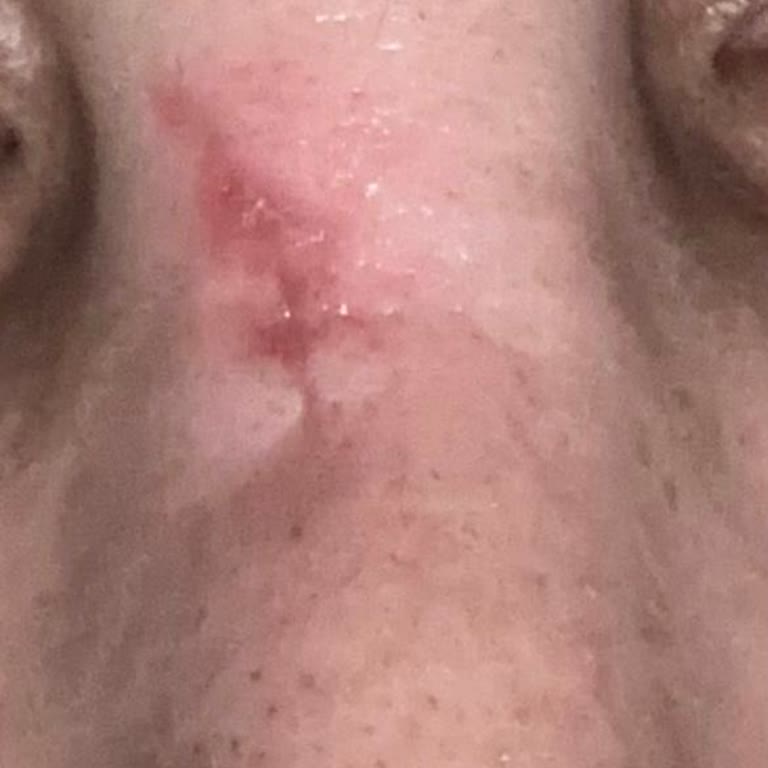 Ameliyat Sonrası Beklenmedik İz Ve Hayal Kırıklığı