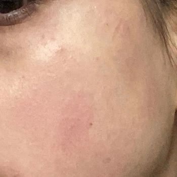 Cosmed Ciltte Alerjik Reaksiyon Ve Kızarıklık Sorunu