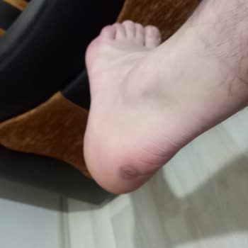 Skechers Ayakkabılarla Yürüyüş Keyfi Kabusa Döndü!