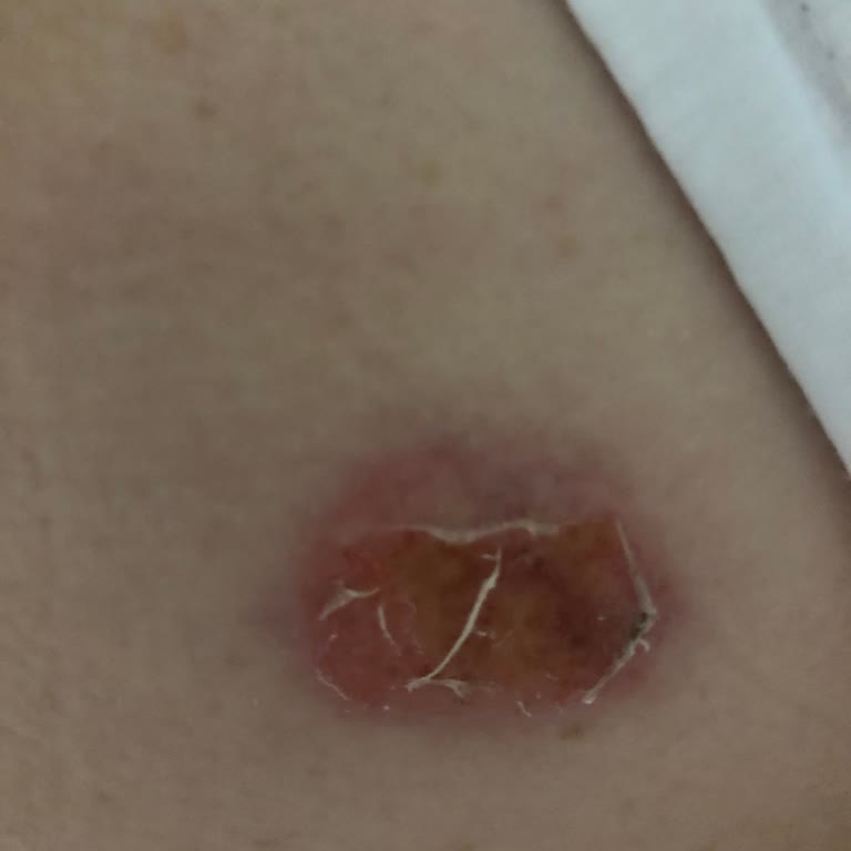 Isı Bandı Yanığı: Annemin Acısını Artırdı