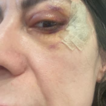 Medistanbul Hastanesi Başarısız Ameliyatın Ücret İadesi Yapılmadı!