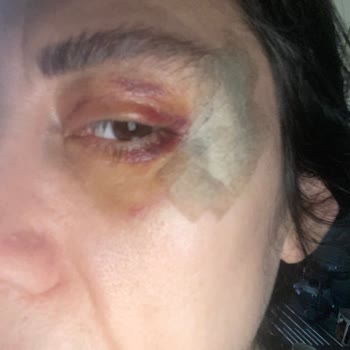 Medistanbul Hastanesi Başarısız Ameliyatın Ücret İadesi Yapılmadı!