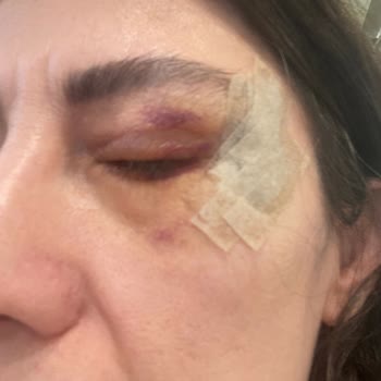 Medistanbul Hastanesi Başarısız Ameliyatın Ücret İadesi Yapılmadı!