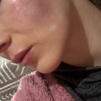 Genosys BBC Güneş Kremi Ciddi Yanma Ve Kızarıklık Oluşturdu