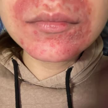 Türkiye Hastanesi Yanlış Tedavi Ve İhmal Sonucu Kalıcı Hasar