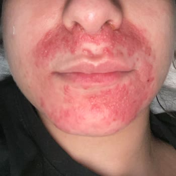 Türkiye Hastanesi Yanlış Tedavi Ve İhmal Sonucu Kalıcı Hasar