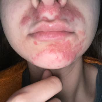 Türkiye Hastanesi Yanlış Tedavi Ve İhmal Sonucu Kalıcı Hasar