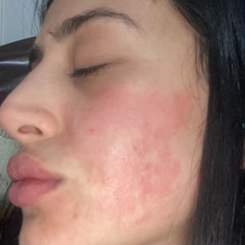 Yves Rocher Yüzümü Berbat Etti, Tüketici Hakları'na Gideceğim!
