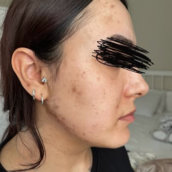 Dr. Abuzer Gaffar Atlı - Epidermal Güzellik Salonunda Yapılan Lazer İşlemi Sonrası Kalıcı Lekeler