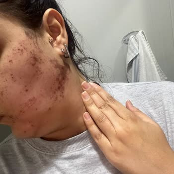 Dr. Abuzer Gaffar Atlı - Epidermal Güzellik Salonunda Yapılan Lazer İşlemi Sonrası Kalıcı Lekeler