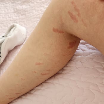 Lazer Epilasyon Sonrası 2. Derece Yanık Ve İz Kalma Endişesi