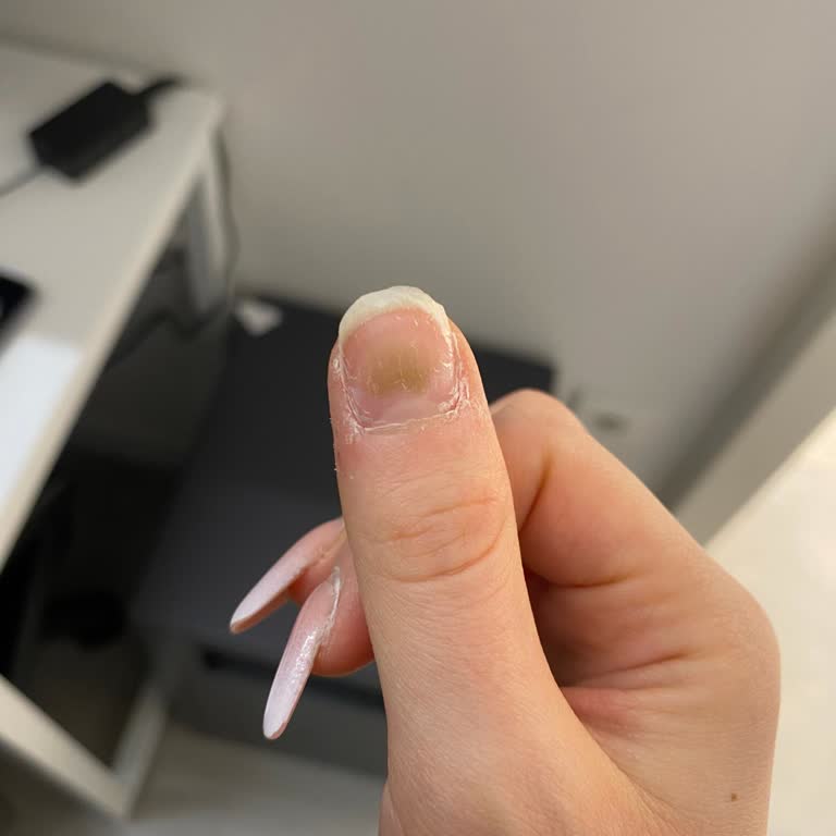 Hazan Nail Bar Tırnak Yapımı Sonrası Mantar Oluştu!