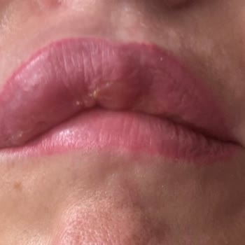 Dolgu Faciası: Aylardır Geçmeyen Ağrı Ve Şişlik