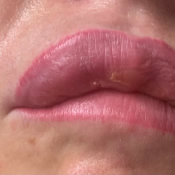 Dolgu Faciası: Aylardır Geçmeyen Ağrı Ve Şişlik