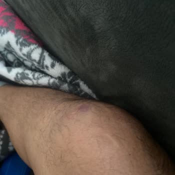 Onvo Scooter Fren Arızası: Hayati Tehlike