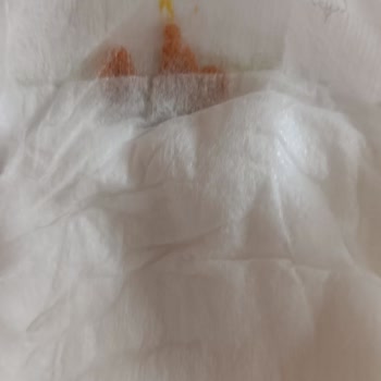 Bebek Bezinde Beklenmedik Sorun