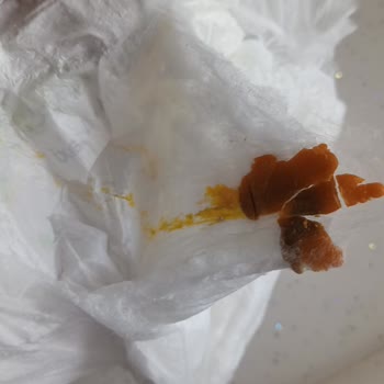 Bebek Bezinde Beklenmedik Sorun