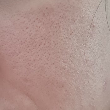 Plazma Pen Seansı Sonrası Cilt Sorunları Ve İlgisizlik