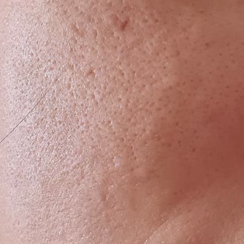 Plazma Pen Seansı Sonrası Cilt Sorunları Ve İlgisizlik