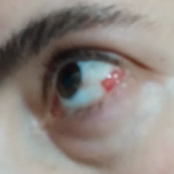 Göz Kremi Kullanımı Sonrası Ciddi Göz Kanlanması