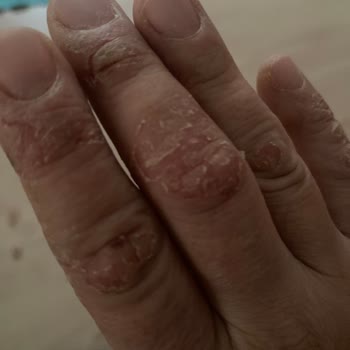 Tefal Rondo Yedek Parça Sıkıntısı