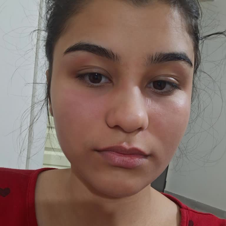 Bee Beauty Pirinç Maskesi İle Cilt Yanığı