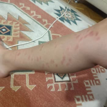 Lazer Cihazı Kullanımı Sonrası Ciddi Yanık Problemi