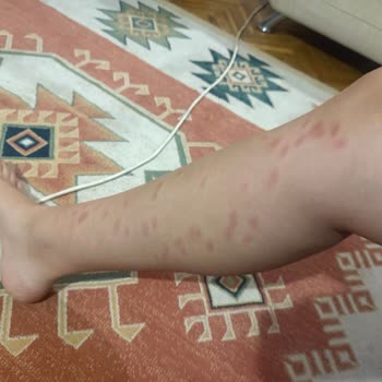 Lazer Cihazı Kullanımı Sonrası Ciddi Yanık Problemi