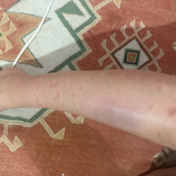 Lazer Cihazı Kullanımı Sonrası Ciddi Yanık Problemi