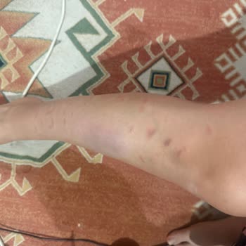 Lazer Cihazı Kullanımı Sonrası Ciddi Yanık Problemi