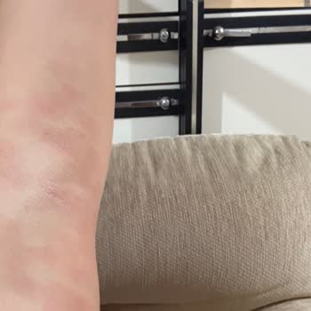 Lazer Cihazı Kullanımı Sonrası Ciddi Yanık Problemi