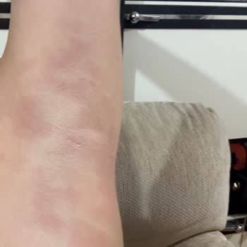 Lazer Cihazı Kullanımı Sonrası Ciddi Yanık Problemi