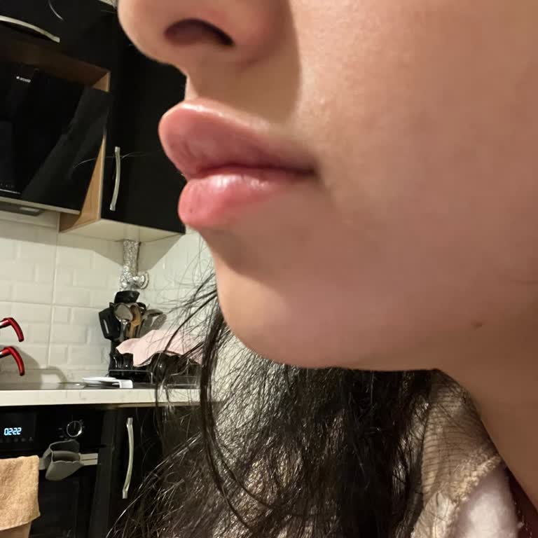 Dudak Ve Çene Dolgusunda Kötü Deneyim