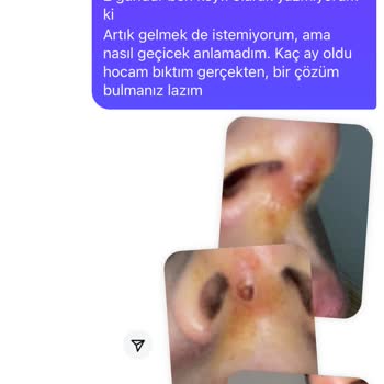 Başarısız Burun İp Askı İşlemi Sonrası Süregelen Sorunlar