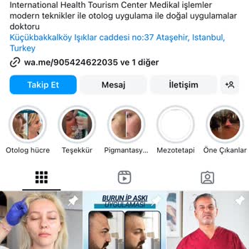 Başarısız Burun İp Askı İşlemi Sonrası Süregelen Sorunlar
